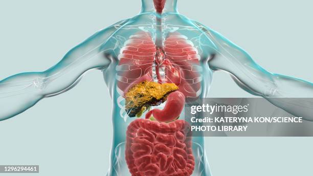 liver cirrhosis, illustration - cirrhosis 幅插畫檔、美工圖案、卡通及圖標