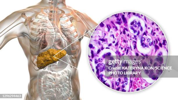 ilustrações de stock, clip art, desenhos animados e ícones de liver cirrhosis, illustration and light micrograph - porta do fígado