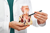Treatment of rectal diseases, hemorrhoid. Proctologist pointing pen rectum pathologies on an anatomical model