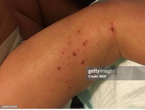 Eczema, or atopic dermatitis, is an inflammatory skin condition that affects an estimated 30 percent of the U.S. Population, mostly children and...