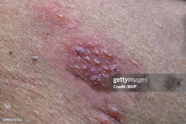 Shingles Cover Rash 60 Shingles Rash Images Stock Photos, High-Res Pictures, and Images ...