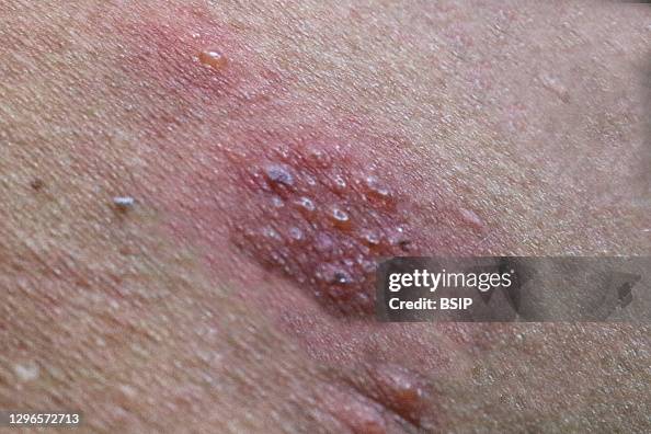 Shingrix Outbreak Rash Rash associated with the shingles virus.Credit: NIAID News Photo ...