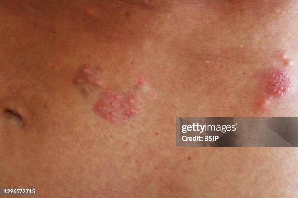 Rash associated with the shingles virus.Credit: NIAID