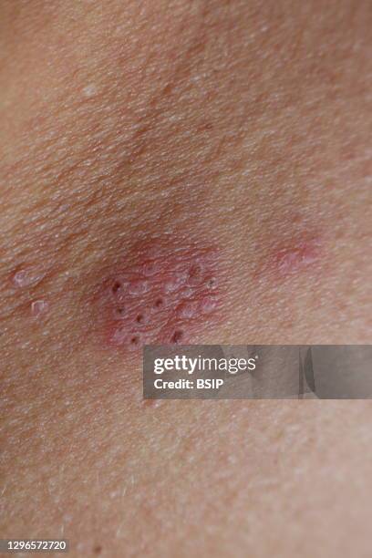 Shingles Rash Description Circular Shingles Rash – Early Stages Of Shingles – JNSYU