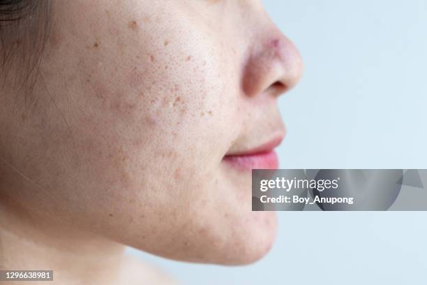 cropped shot of woman having problems of acne inflamed and acne scar on her face. - complexion imagens e fotografias de stock