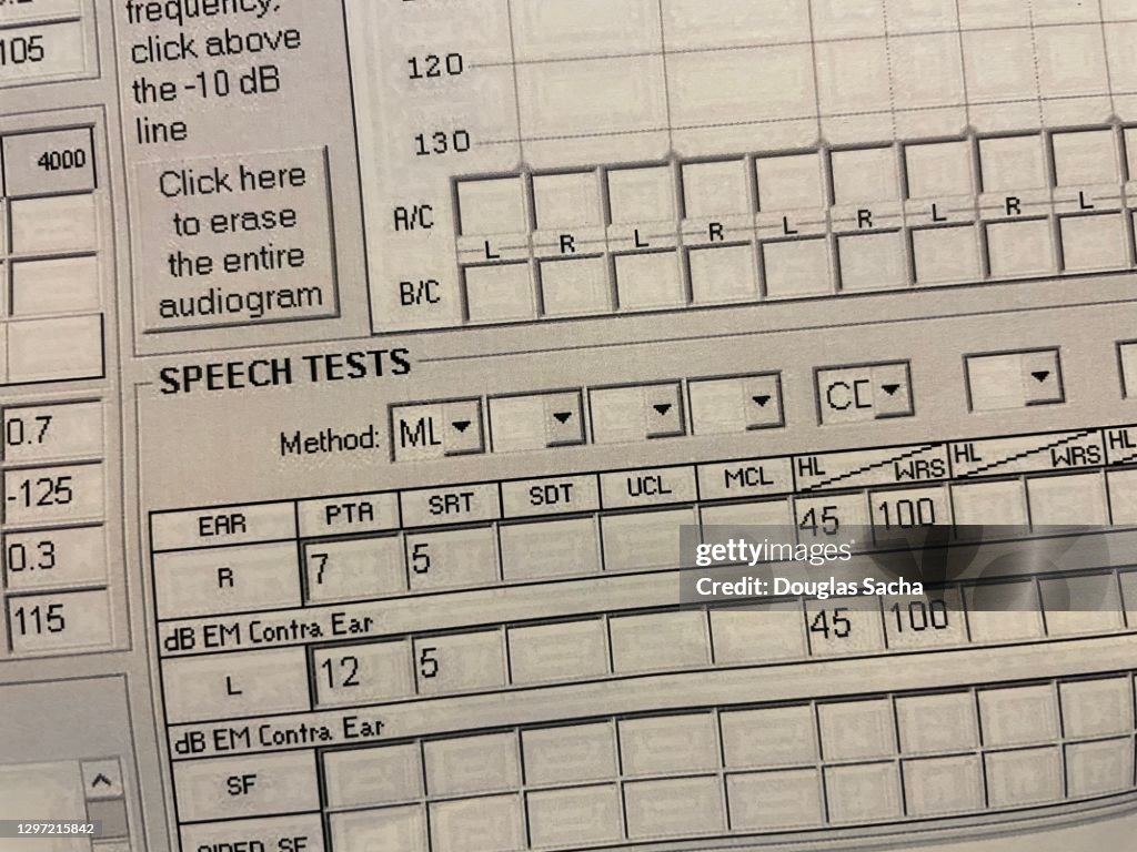 Audiogram Test Graph Test Graph Results Of Electrophysiological Audiogram For Hearing Loss ...