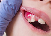 Painful pus-filled swelling abscess in the gum of the mouth in a 8 year old child.