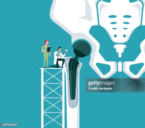 structure of the artificial hip joint - hip surgery stock illustrations