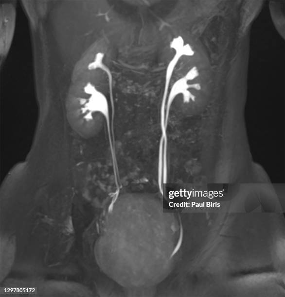 mri  urography, bilateral duplicated collecting system - body scans stock-fotos und bilder