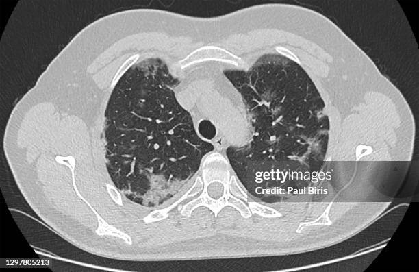 computed tomography scan in a patient with viral pneumonia caused by sars-cov-2 - cat scan machine stock pictures, royalty-free photos & images