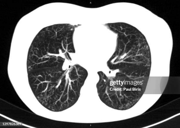 tree-in-bud sign or pattern on the ct lung images - lung and normal ct scan stockfoto's en -beelden