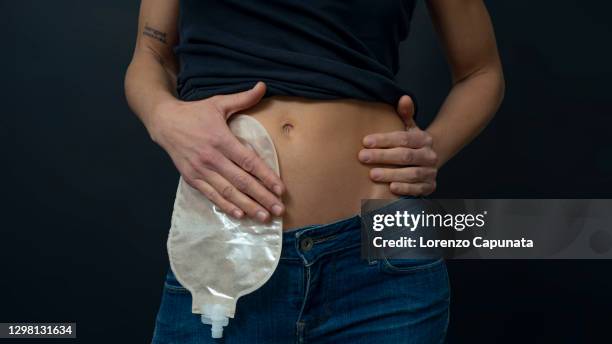 studio shot of a woman, that show her abdomen and a ostomy bag. cancer concept. - cólon imagens e fotografias de stock