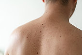 Close up detail of the bare skin on a man back with scattered moles and freckles
