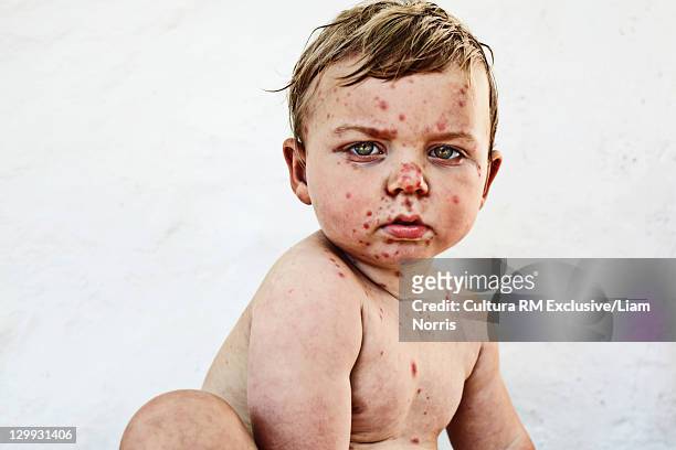 messy toddler boy - chickenpox stock pictures, royalty-free photos & images