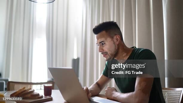 young man with vitiligo using laptop at home - vitiligo stock pictures, royalty-free photos & images