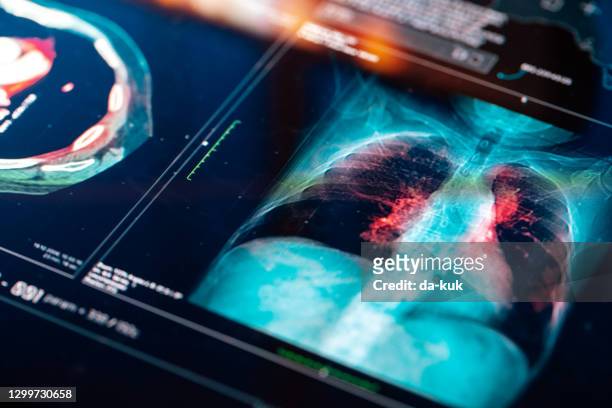 medizinischer mrt-scan - lunge stock-fotos und bilder