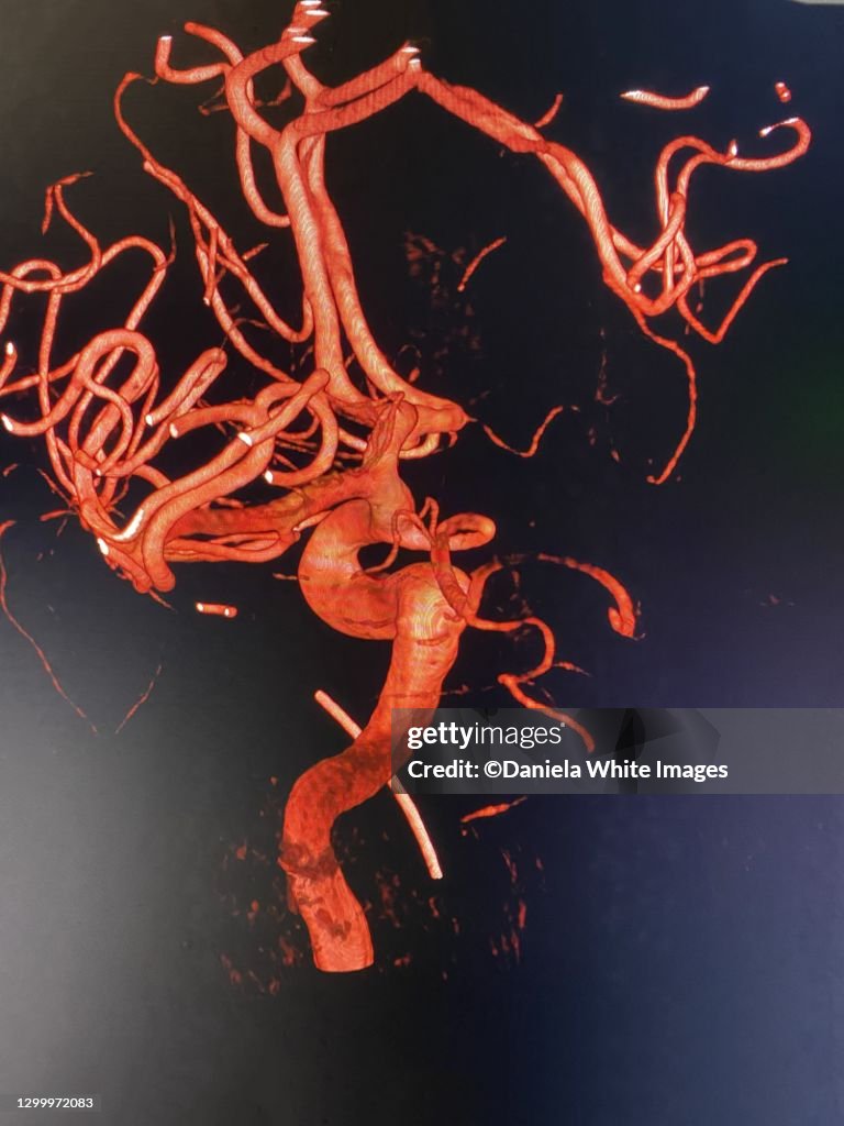 3D Arteriogram of the brain