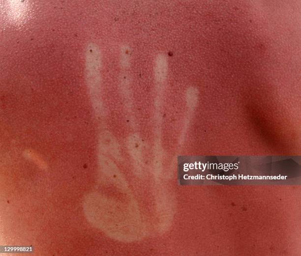 sunburn hand-print - sunburn stock-fotos und bilder