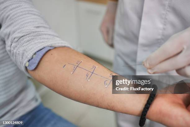arts die alergy test op de wapen van een patiënt uitvoert - allergy doctor stockfoto's en -beelden
