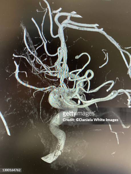 cerebral artery (carotid artery) - human artery foto e immagini stock
