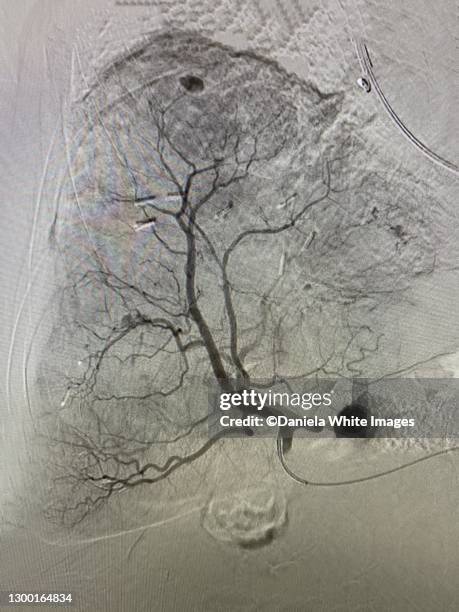 radiography of liver arteries - lazio medical tests stock pictures, royalty-free photos & images