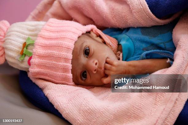 Yemeni malnourished child, Husain Ali Hassan, 6-months old, lies on a bed while he receives medical treatment at the malnutrition treating department...