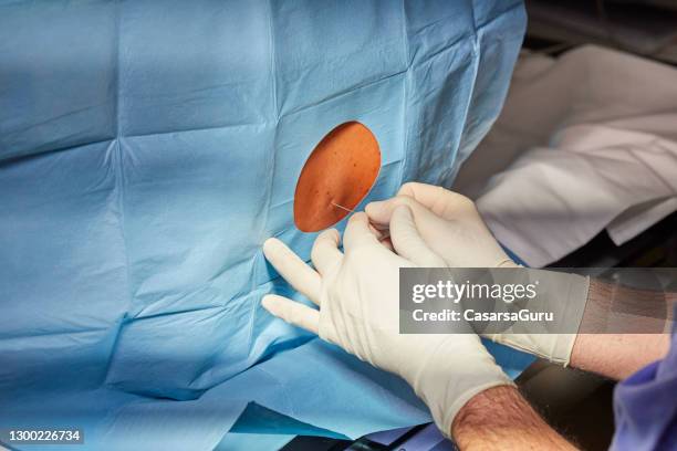 doctor is inserting a fine plastic tube called an epidural catheter into a patient's back - backstube stock pictures, royalty-free photos & images