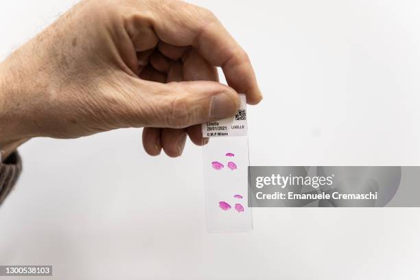 Dermatopathologist Raffaele Gianotti handles a skin biopsy slide at the Dermatopathology Department of Ca Granda Ospedale Maggiore Policlinico on...