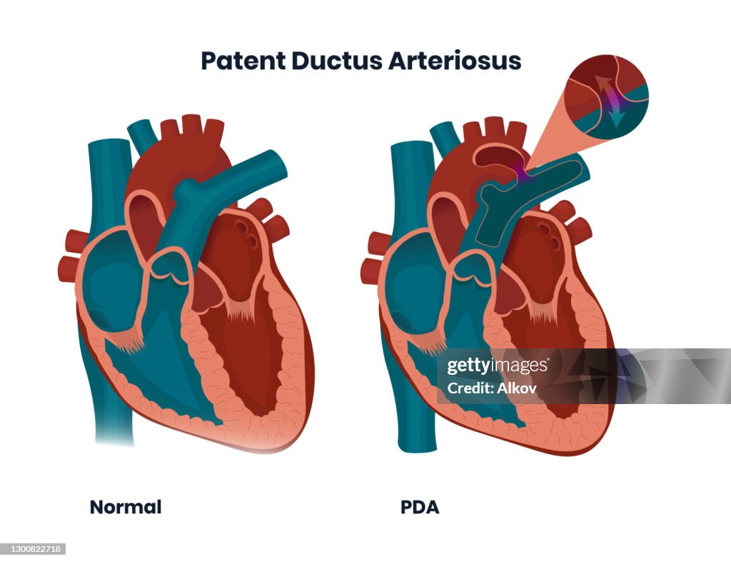 Patent Ductus Arteriosus With Normal Heart Anatomy Illustration Of The ...