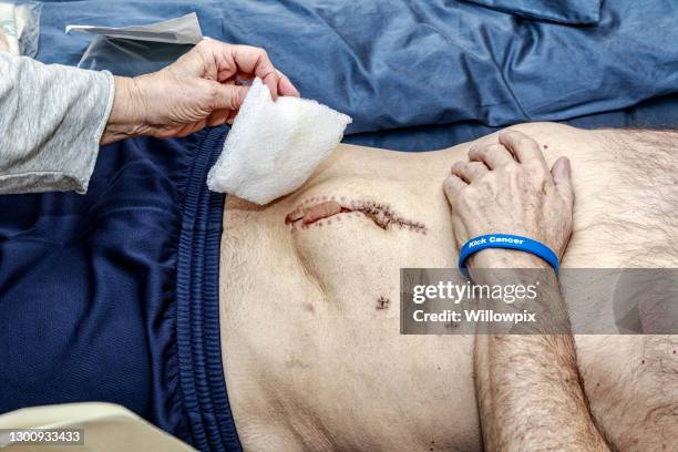 home caregiver bandaging cancer surgery abdominal wound - hand laceration stock pictures, royalty-free photos & images