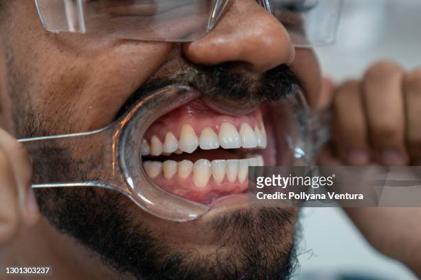 retractor dental - odontología cosmética fotografías e imágenes de stock
