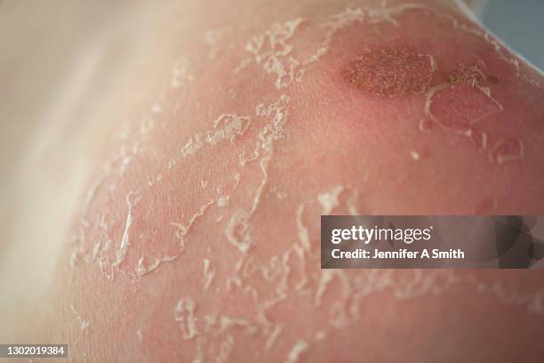 sunburn - sunburned stockfoto's en -beelden