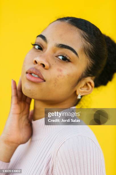 young girl with acne - hautfleck stock-fotos und bilder