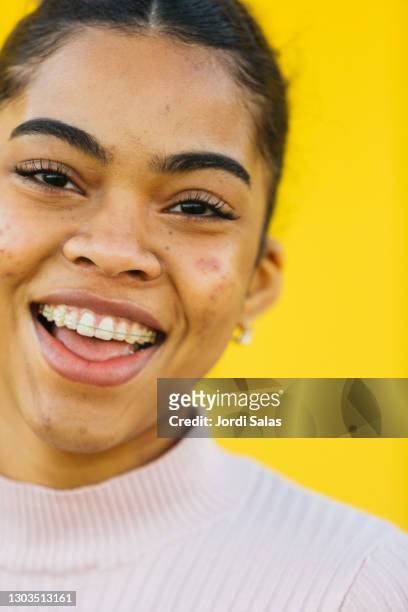 young girl with acne - imperfection stockfoto's en -beelden