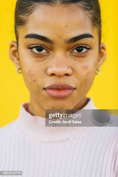 young girl with acne - onvolkomenheid stockfoto's en -beelden