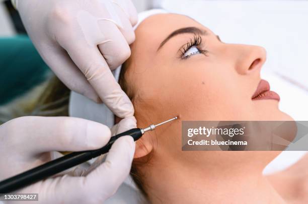 mole removal - mole stock pictures, royalty-free photos & images