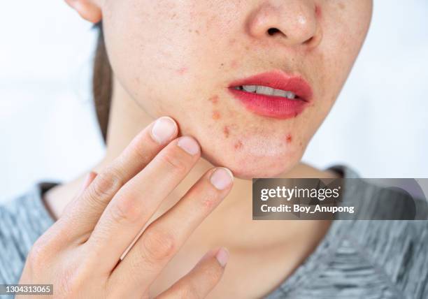 cropped shot of woman having problems of acne inflamed on her lower face. - pimple stockfoto's en -beelden