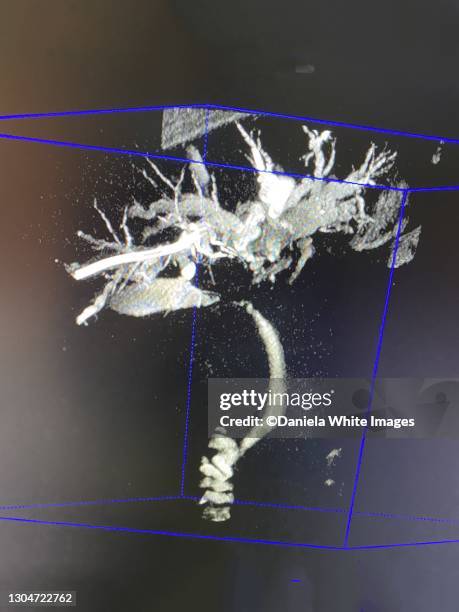 xray of liver, bile ducts, intestine - common-bile-duct stock pictures, royalty-free photos & images