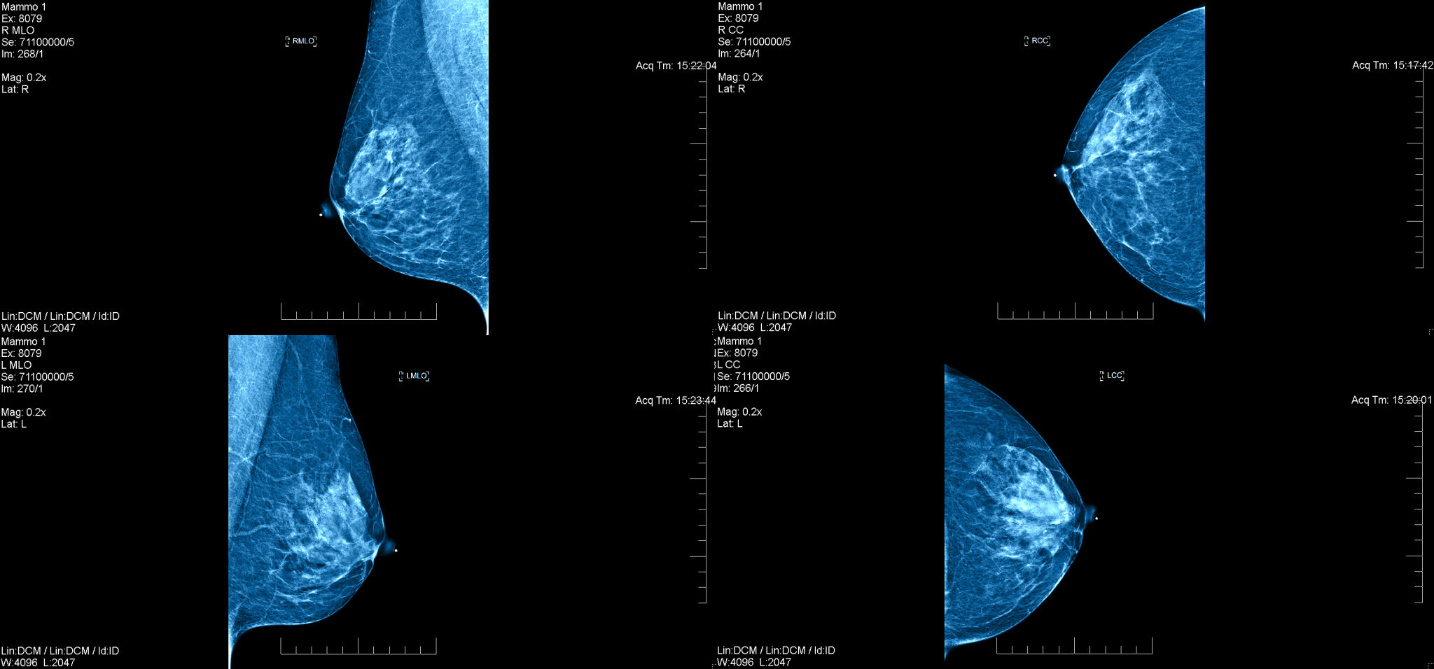 mammogram screening