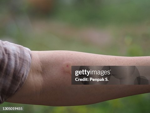 Wasp,hornet stings arm woman red swelling Wasp,hornet stings arm woman red swelling
