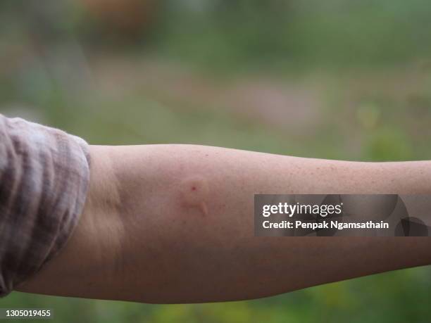 wasp,hornet stings arm woman red swelling - stich stock-fotos und bilder