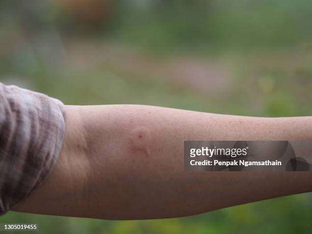 wasp,hornet stings arm woman red swelling - artrópodo fotografías e imágenes de stock