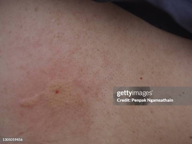 wasp,hornet stings arm woman red swelling - stechen tierverhalten stock-fotos und bilder