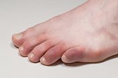 Covid toes. Coronavirus symptoms - swelling and discoloration, purplish color, pain and rough skin.