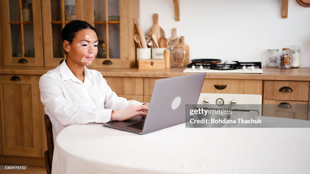 Young latin woman with vitiligo use laptop at kitchen table