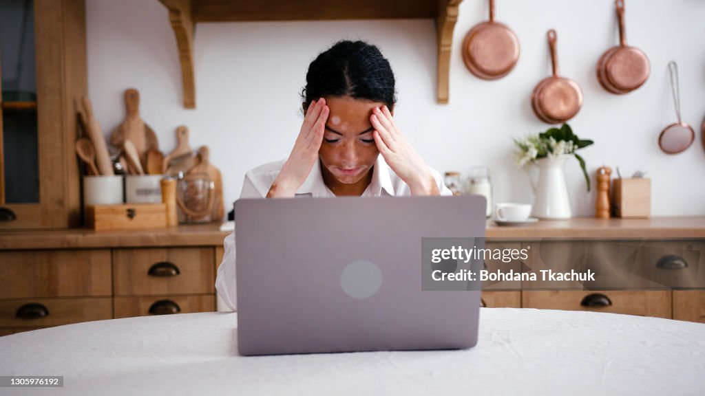Young latin woman with vitiligo with laptop suffer headache at kitchen