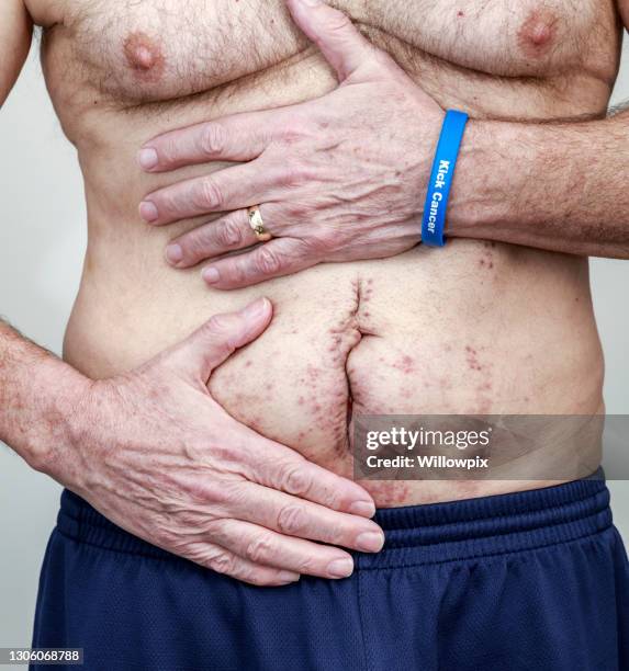 高級男子腹部結腸直腸癌腫瘤手術疤痕 - belly ring 個照片及圖片檔