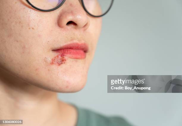 close up of herpes labialis occur on the woman lower lip. - herpes labial - fotografias e filmes do acervo