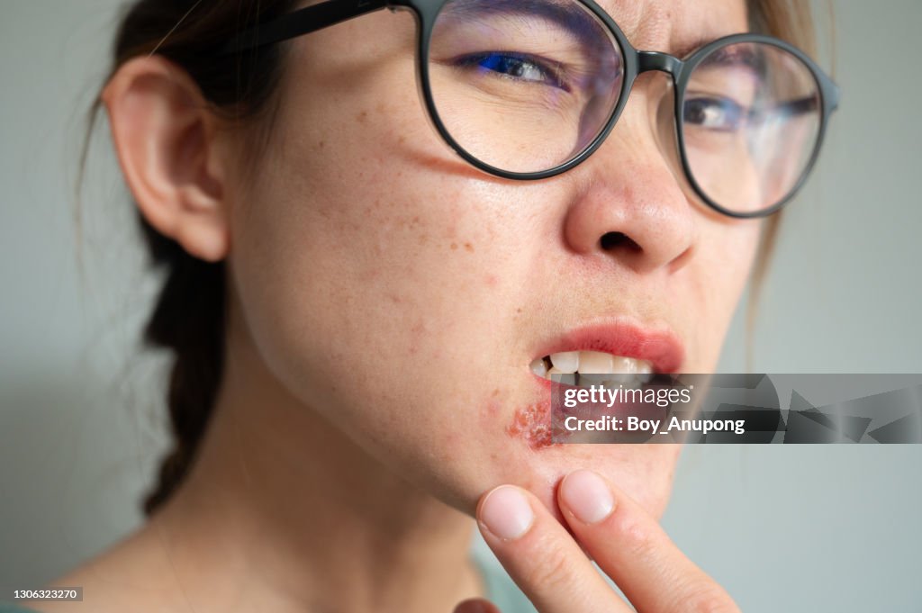 Close up of woman feeling pain from Herpes labialis occur on her lower lip.