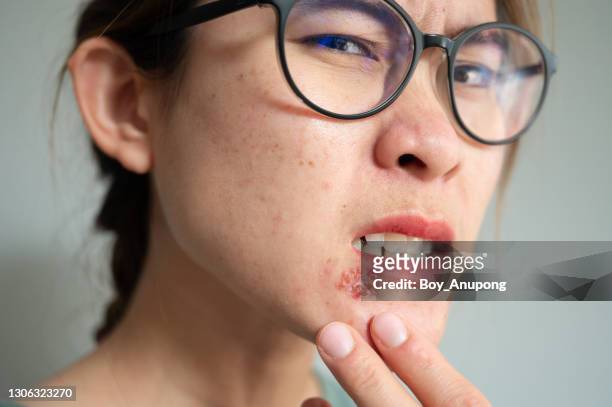 close up of woman feeling pain from herpes labialis occur on her lower lip. - dry eye stock pictures, royalty-free photos & images